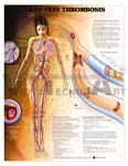 Deep Vein Thrombosis Anatomical Chart